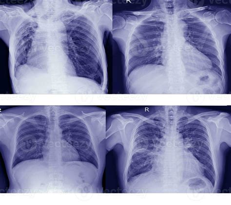 Collection Chest X Ray For Doctors And Medical Professionals To Learn