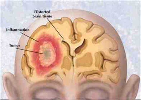 MRI Picture of a Glioblastoma