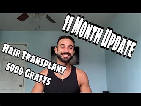 Hair Transplant Month 11 Update 5000 Grafts Asli Tarcan YouTube