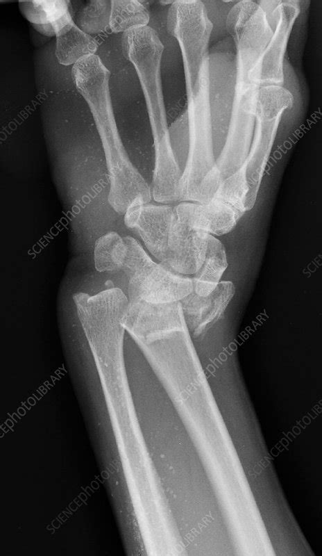 Wrist fracture, X-ray - Stock Image - C039/3360 - Science Photo Library