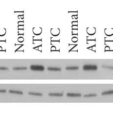 ASPM regulates the Wnt β catenin signaling pathway in ATC cells a