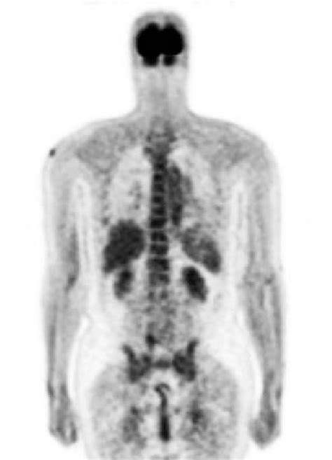 Corresponding Positron Emission Tomography Computed Tomography Image