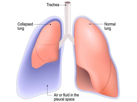 Punctured Lung Pneumothorax Symptoms Treatment And Recovery