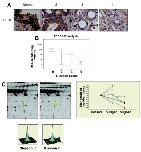 Pedf Expression Decreases With Tumor Grade A Immunohistochemical