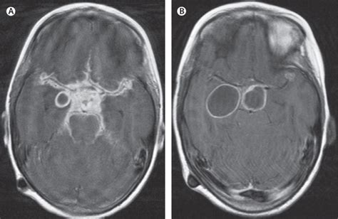 References In Tuberculous Meningitis More Questions Still Too Few Answers The Lancet Neurology