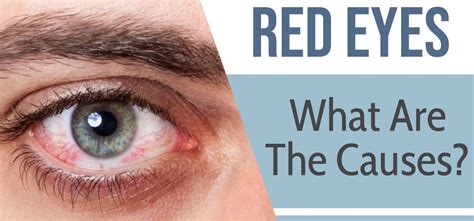 Red Eyes - What are the causes?