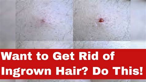 Smooth Skin Secrets How To Get Rid Of Ingrown Hair Fast Youtube