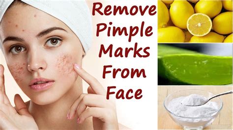 ব্রনের কালো দাগ দূর করার উপায় How To Remove Dark Spots From Face