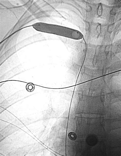 Venous Thromboembolic Disease Case Albany Ir