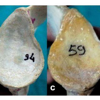 shape of the glenoid cavity | Download Scientific Diagram