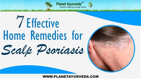 7 Effective Home Remedies For Scalp Psoriasis Youtube