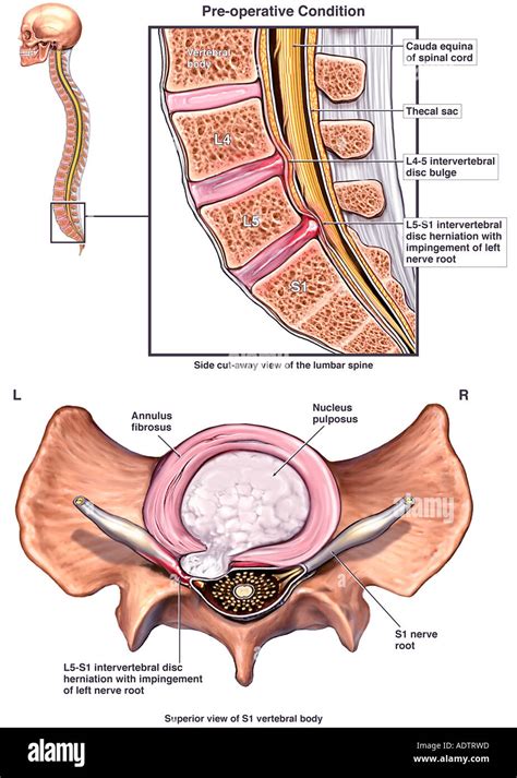 Low Back Injury L Disc Bulge And Herniation Stock Photo Royalty