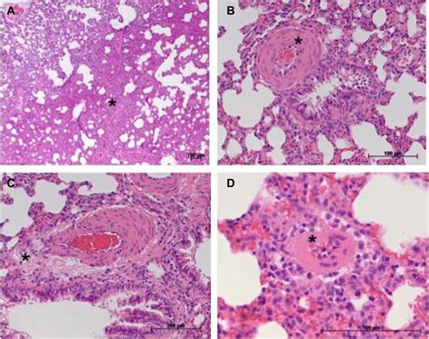 Considerable Histopathological Features Occurring In Damaged Lung