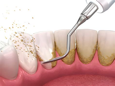 Scaling and Root Planing | Tru Dental