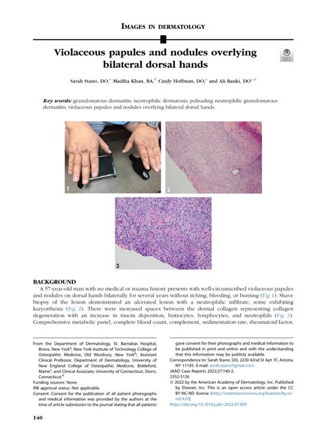 Pdf Violaceous Papules And Nodules Overlying Bilateral Dorsal Hands