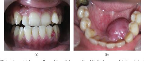 Alveolar Mucosa