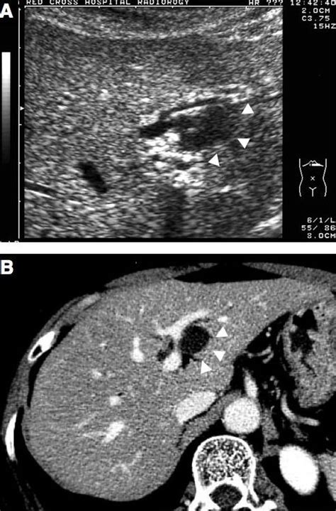 Abdominal Ultrasonography A And Computed Tomography B Show A Cystic