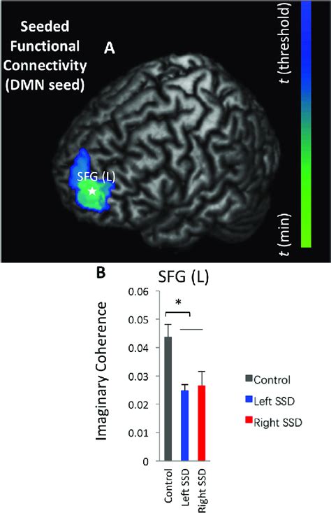 Posterior Cingulate Cortex Seeded Functional Connectivity Difference In