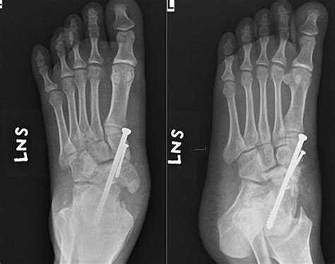 Spontaneous Osteonecrosis Of Navicular And Talus Sonnt Journal Of