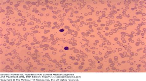 Microcytic Anemia Flashcards Quizlet