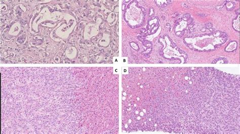 The Pathological Features Of Large Duct Intrahepatic Cholangiocarcinoma