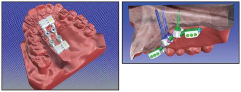 Tandem Skeletal Expander And Mapa Protocol For Palatal Expansion In