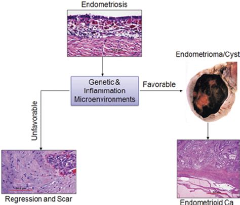 The Natural History Of Human Endometriosis Ectopic Endometriotic