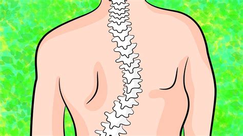 How To Get Rid Of Upper Back Scoliosis In 4 Minutes A Day Youtube