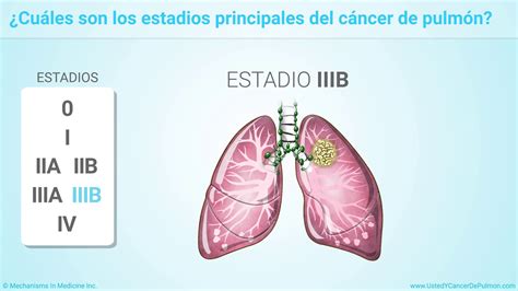 Etapa 2 Del Cancer De Pulmon