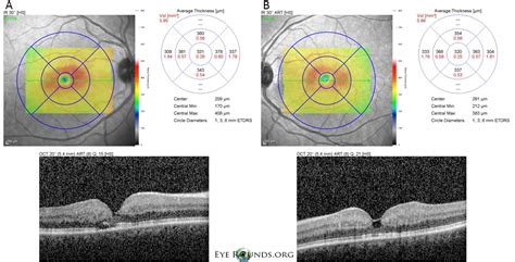 Idiopathic Juxtafoveal Retinal Telangiectasis