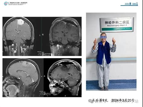 纵裂入路及镰旁脑膜瘤的手术治疗 脑医汇 神外资讯 神介资讯