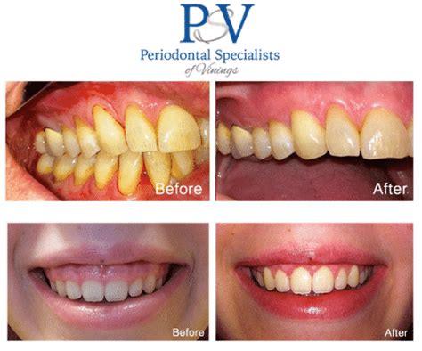 Periodontitis Treatment