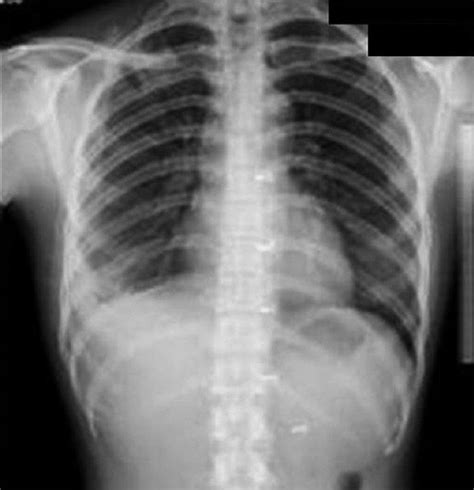 Pneumocystis Carinii Pneumonia Atypical Features Chest X Ray Shows Download Scientific Diagram