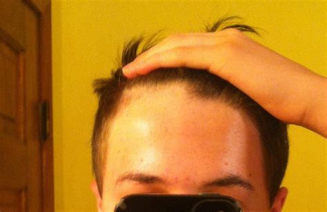 My Crappy Hairline Any Advice Malehairadvice