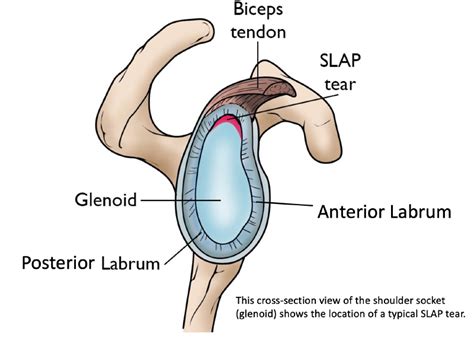 Slap Tears Dr Pant Sydney Shoulder Unit