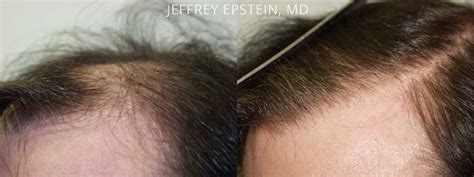 Hair Transplants For Men Photos Miami Fl Patient38807