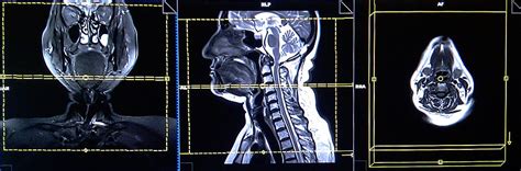 MRI mri soft tissue neck planning and protocols | indications for MRI neck scan