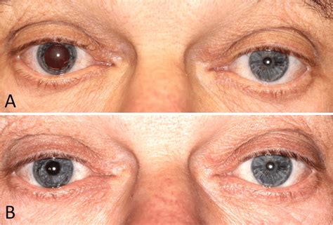 Patient Before And After Combined Artificial Iris And Iol Implantation