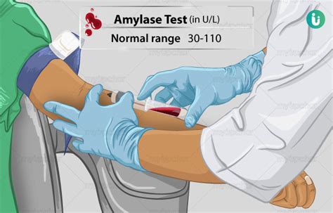 एमइलज टसट कय ह खरच कब कय कस हत ह Amylase Test