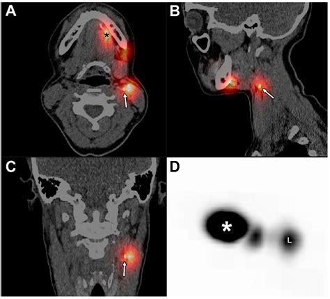 Jcm Free Full Text Ct Lymphography Using Lipiodol® For Sentinel