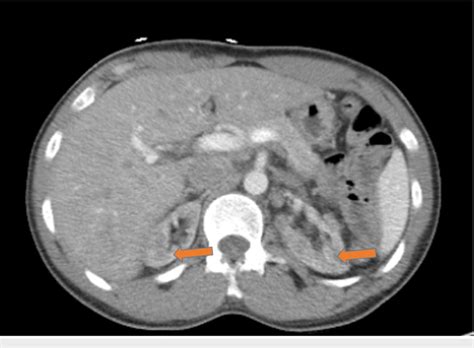 Ct Of The Abdomen And Pelvis Without Intravenous Contrast In An Axial Download Scientific