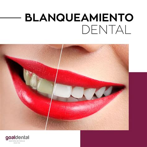 Blanqueamiento Dental Clínicas GoalDental