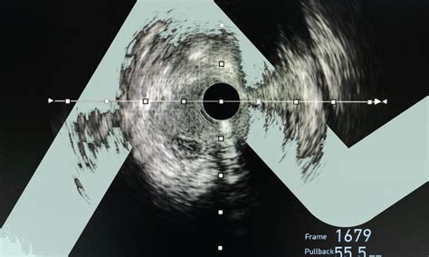 Viewpoint On Future Perspectives For The Percutaneous Treatment Of