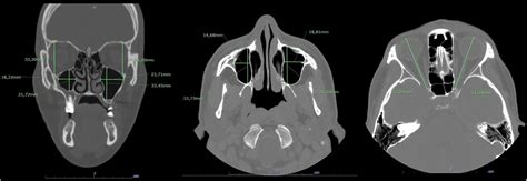 Prevalence Of Maxillary Sinus Hypoplasia And Silent Sinus Syndrome A