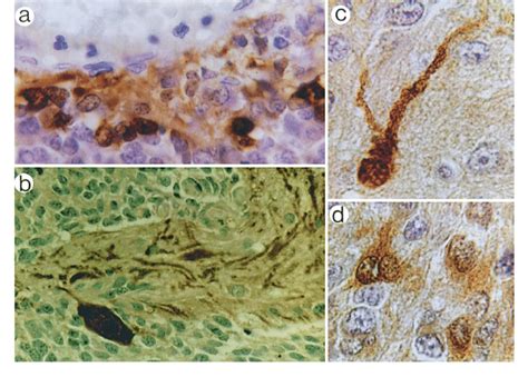 A Classic Medulloblastoma Robust Calbindin D K Staining Of Tumour