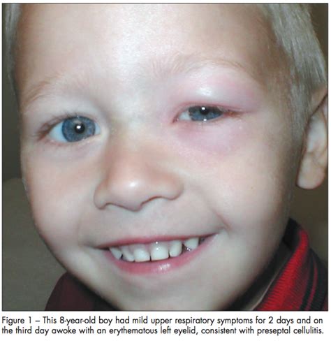 Preseptal Cellulitis Vs Orbital Cellulitis