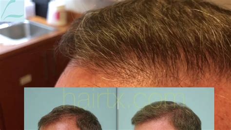 5 Month Early Hd Close Up Video Of Hair Transplant Result Youtube