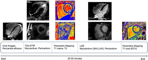 Frontiers Covid 19 Vs Classical Myocarditis Associated Myocardial