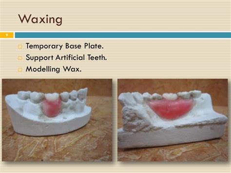 SOLUTION: 8 removeable partial denture steps - Studypool