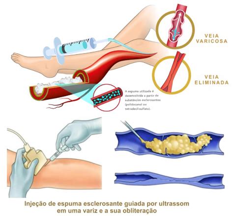 Tratamento De Varizes Espuma Densa M Dica Vascular Especialista